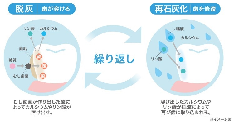 脱灰と再石灰化とは？