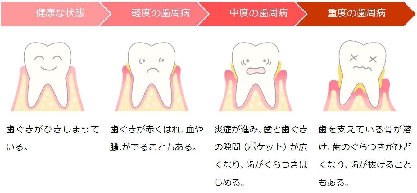 歯周病
