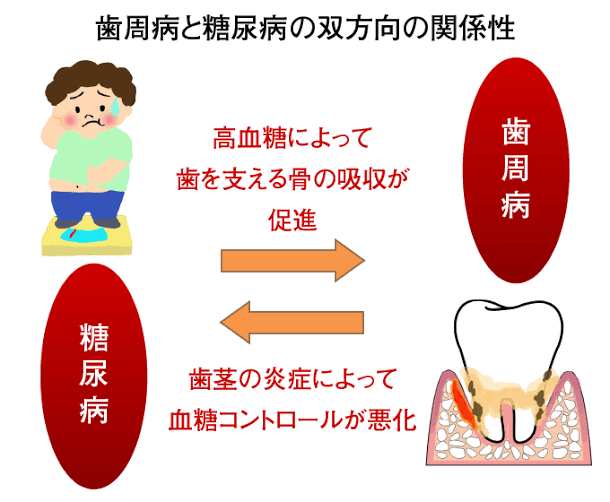 歯周病と糖尿病の関係