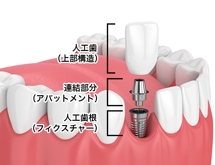 implant２