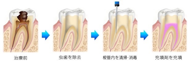 根管