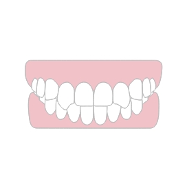 噛み合わせのズレ